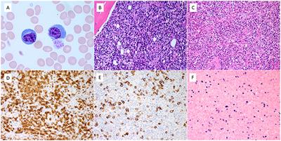 Extreme Peripheral Blood Plasmacytosis Mimicking Plasma Cell Leukemia as a Presenting Feature of Angioimmunoblastic T-Cell Lymphoma (AITL)